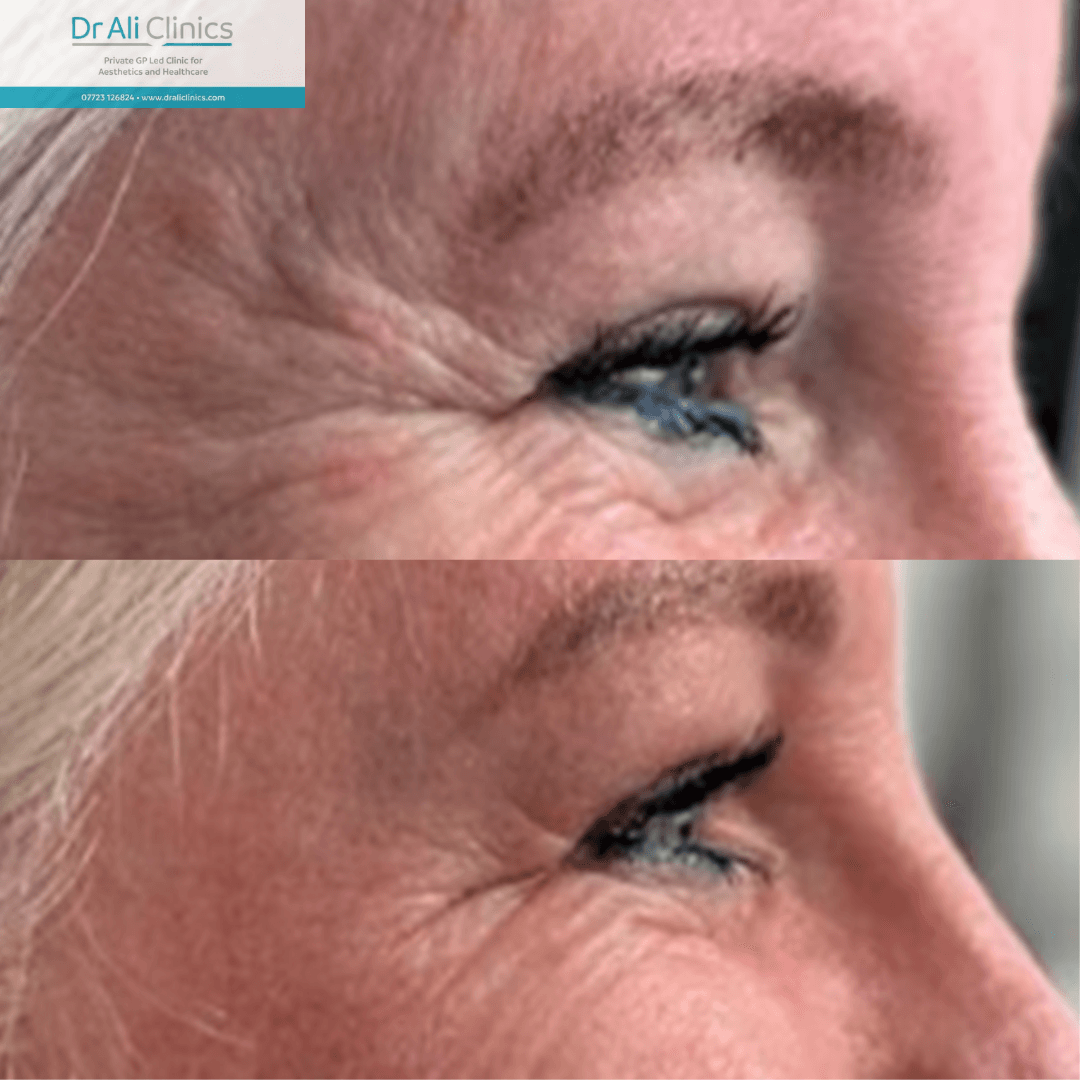 Anti-Ageing Treatment - Before and After