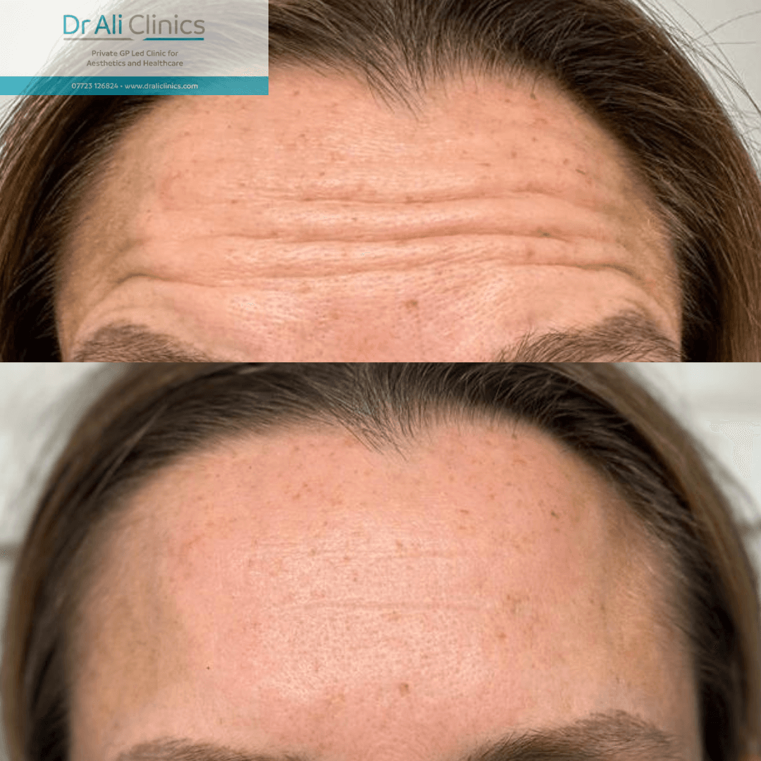 Wrinkle Reduction - Before and After