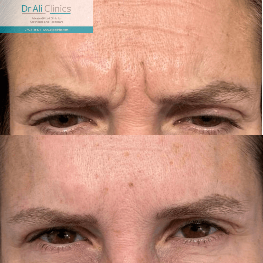 Skin Tightening - Before and After