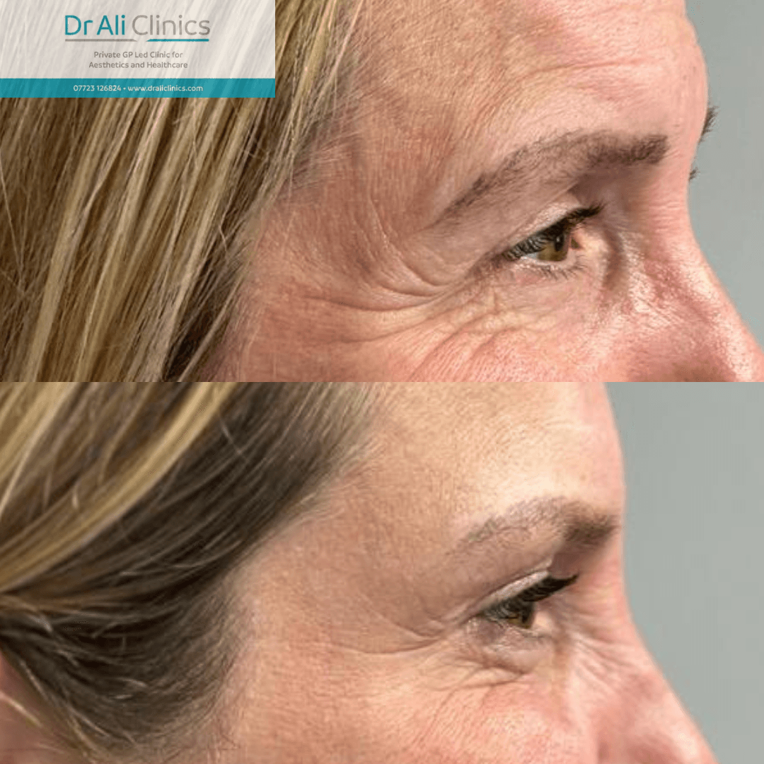 Fine Line Correction - Before and After