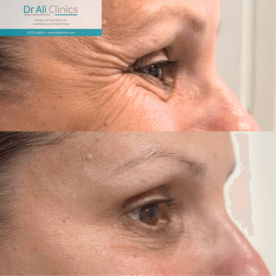 Jawline Definition - Before and After