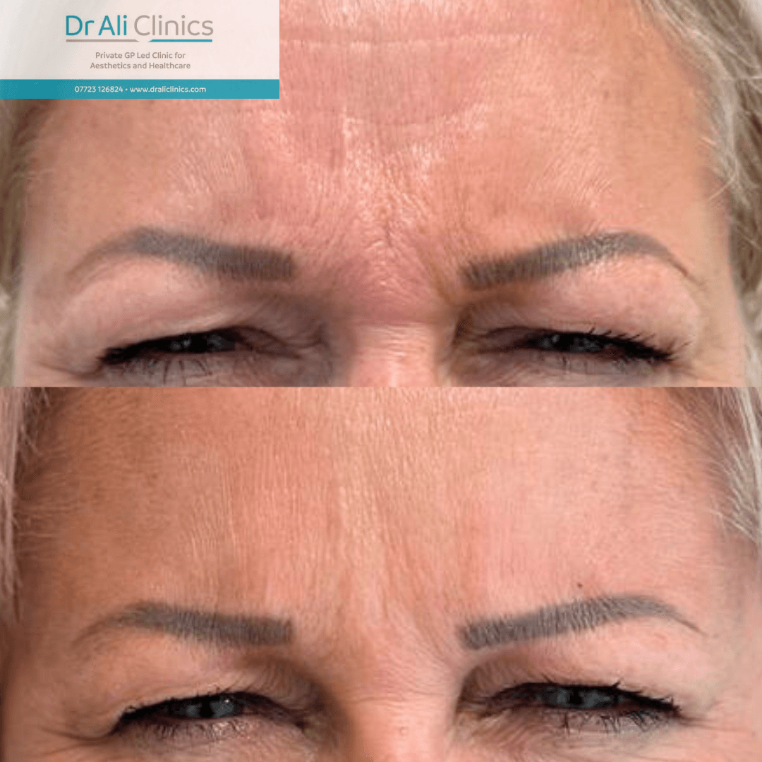 Nasolabial Folds - Before and After