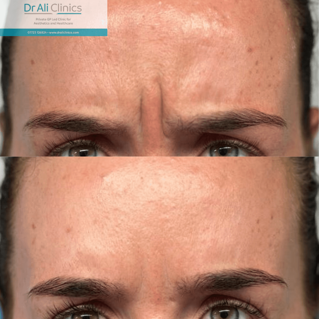 Frown Lines - Before and After