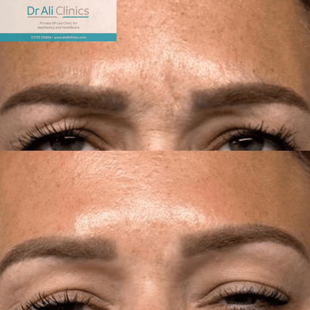 Skin Resurfacing - Before and After