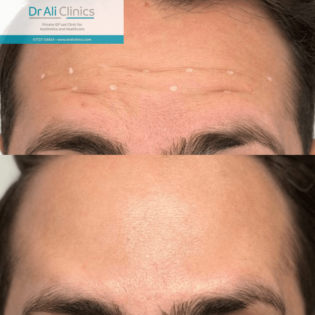 Acne Scar Treatment - Before and After