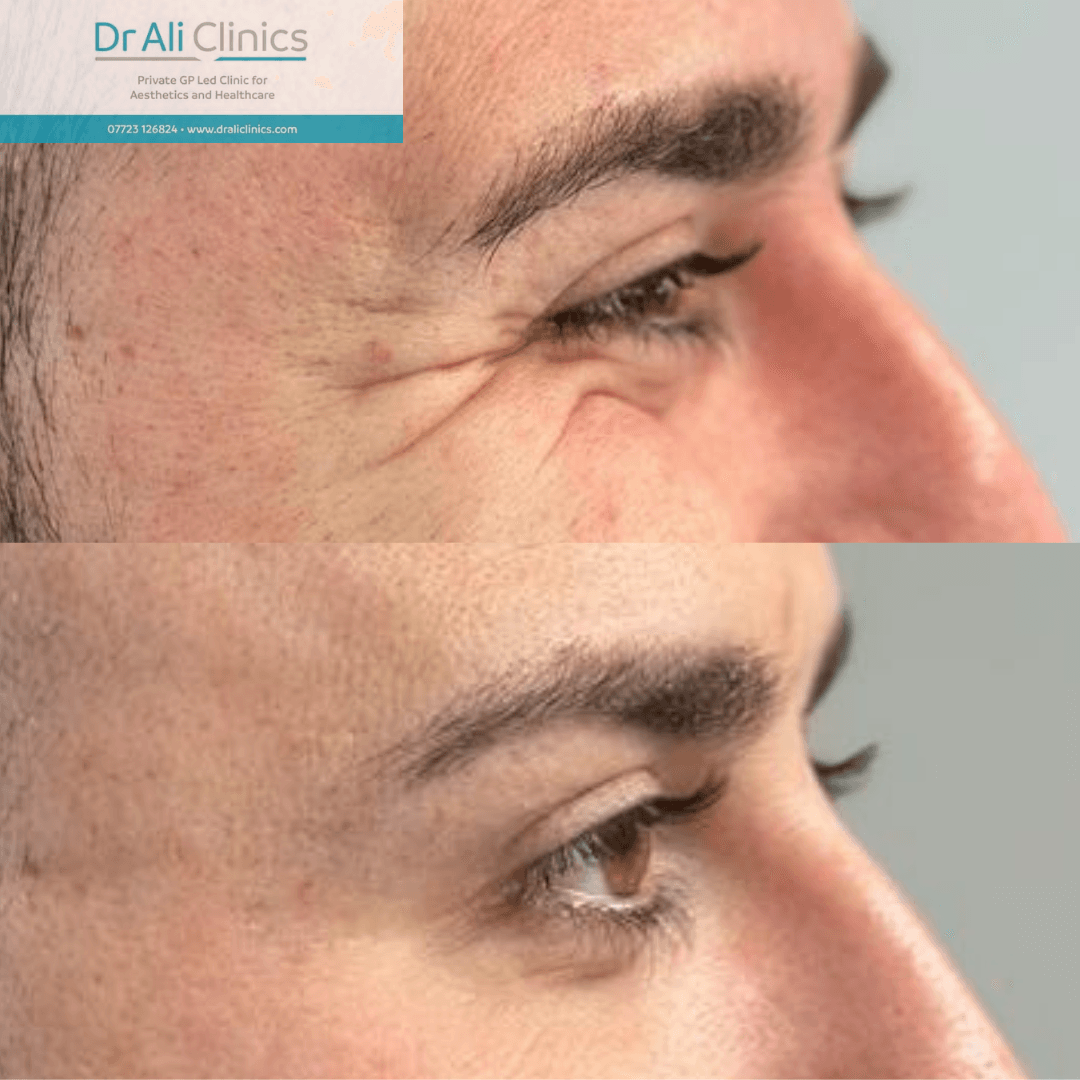 Skin Brightening - Before and After