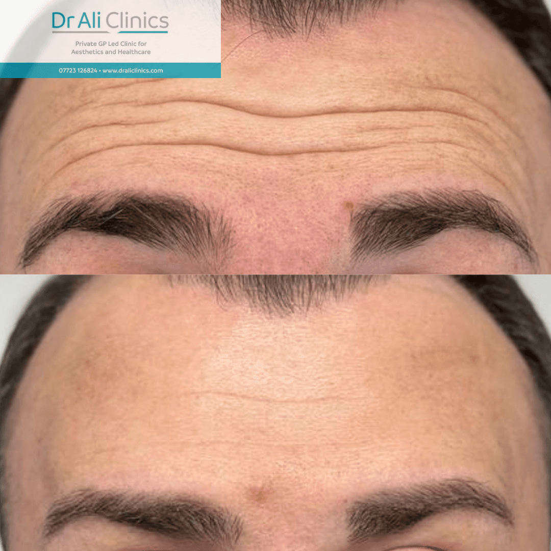 Pigmentation Removal - Before and After