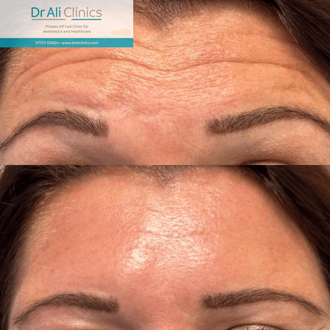 Double Chin Reduction - Before and After