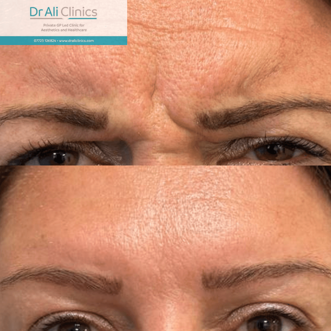 Neck Rejuvenation - Before and After