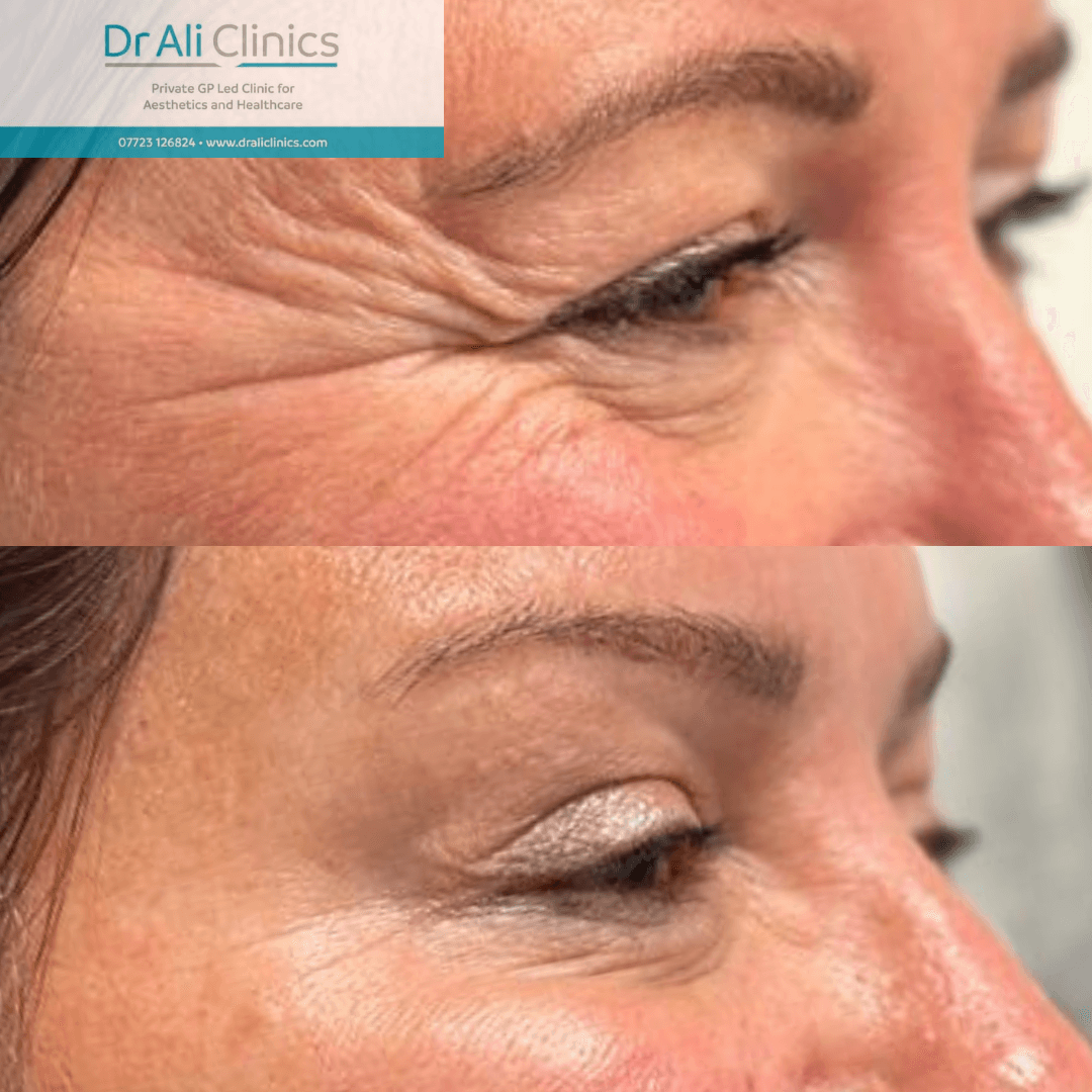 Facial Sculpting - Before and After