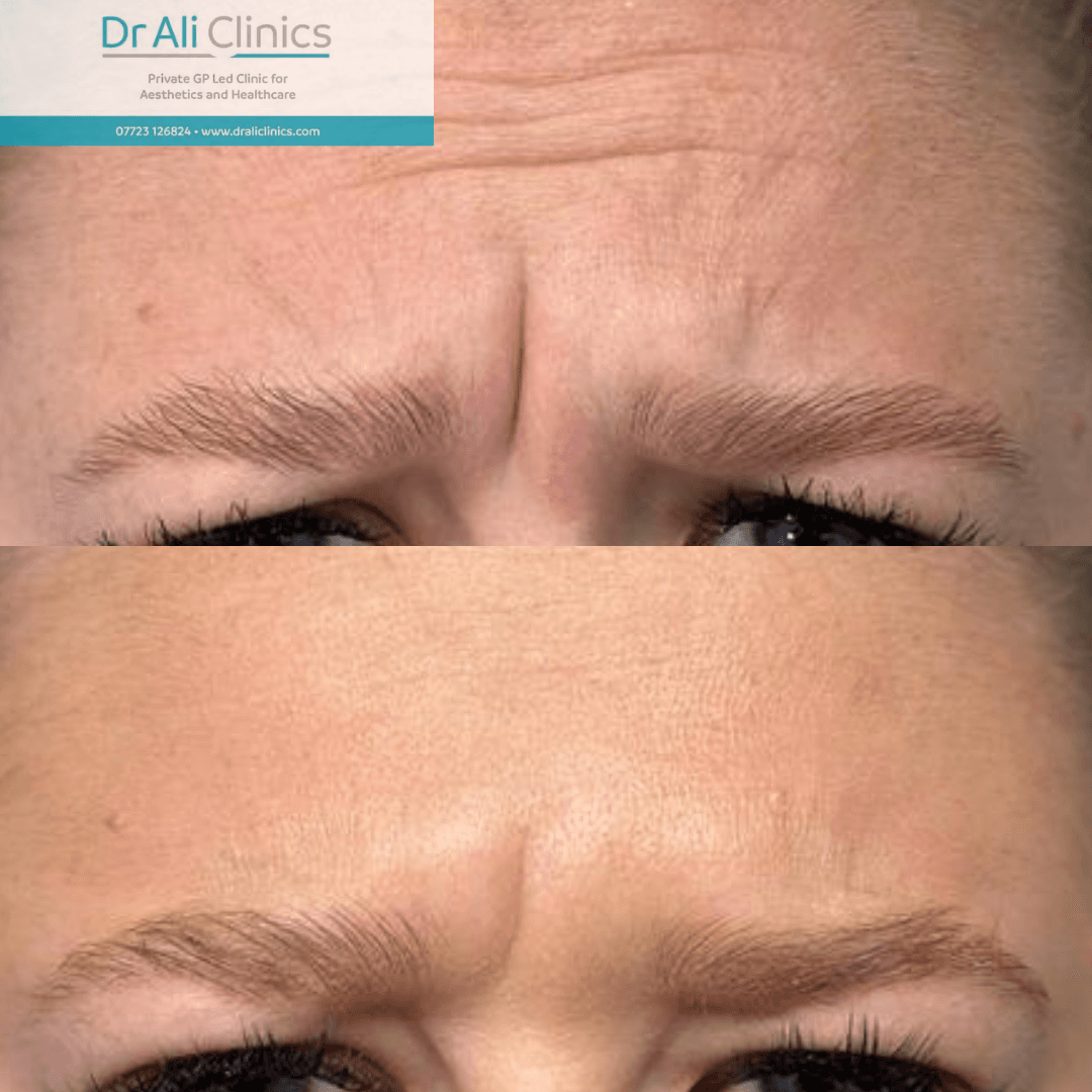 Brow Lift - Before and After
