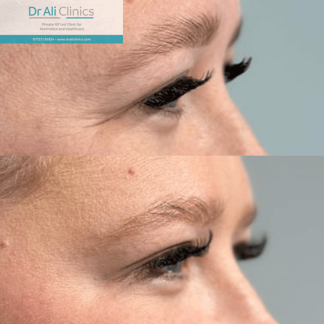 Chin Augmentation - Before and After