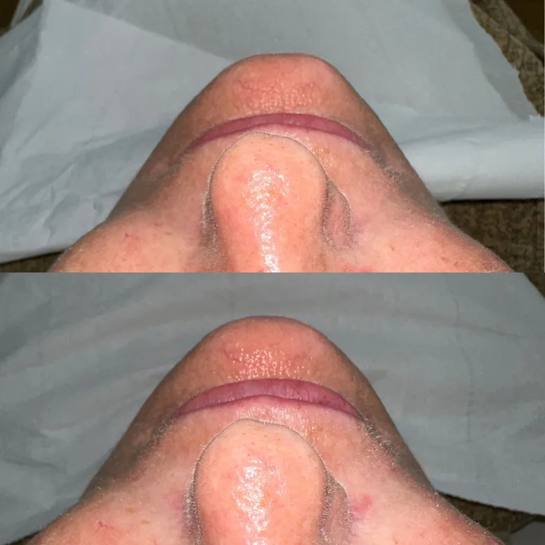 Chin Augmentation - Before and After