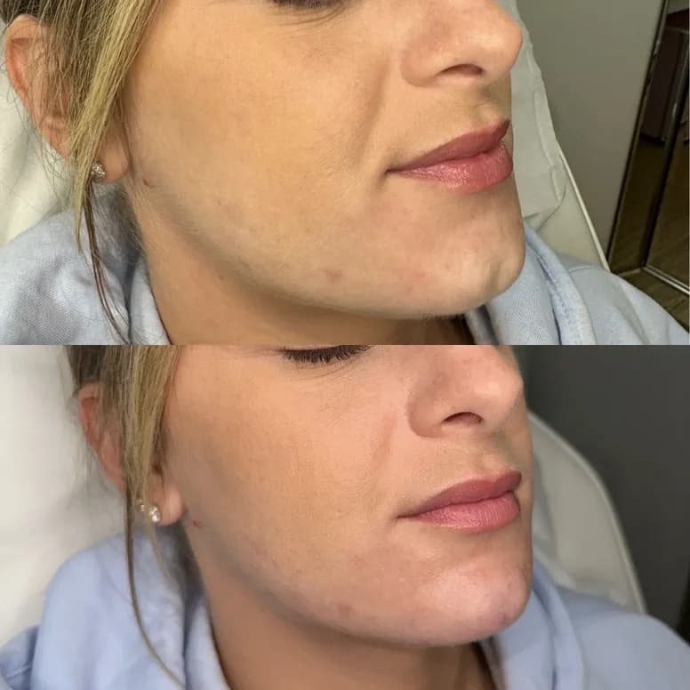 Chin Augmentation - Before and After