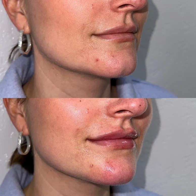Chin Augmentation - Before and After
