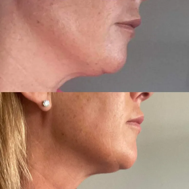Jaw Enhancement - Before and After