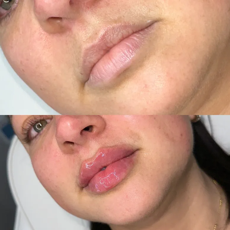 Lip Filler Before and After - Before and After