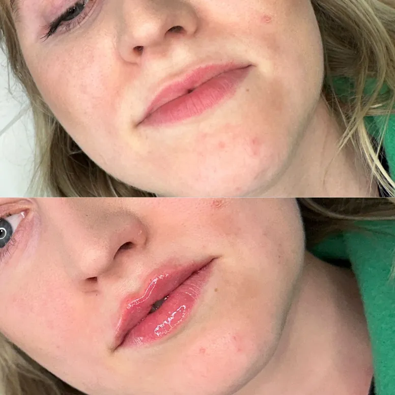 Lip Filler Before and After - Before and After