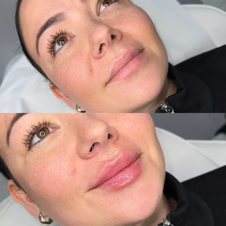 Lip Filler Before and After - Before and After