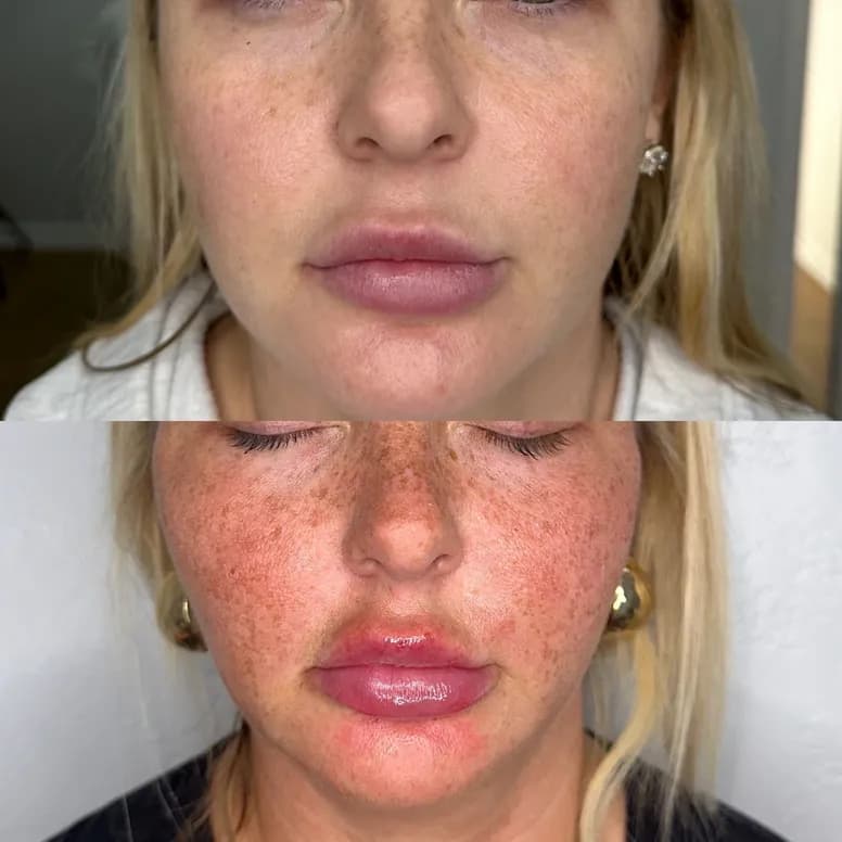 Lip Filler Before and After - Before and After