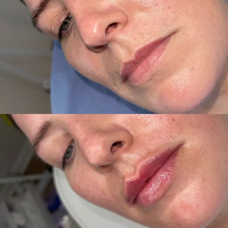 Lip Filler Before and After - Before and After