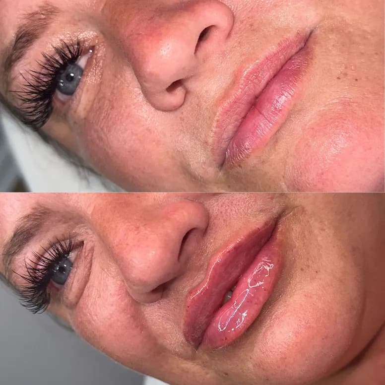 Lip Filler Before and After - Before and After