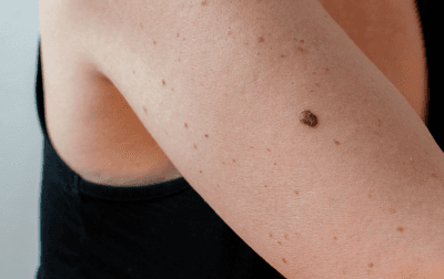 Online assessment for skin lesion