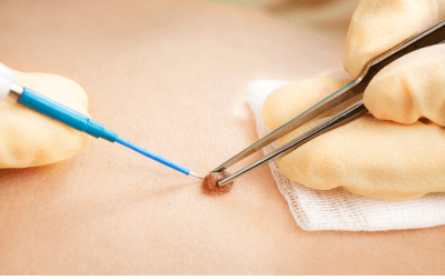 Minor skin procedure being performed