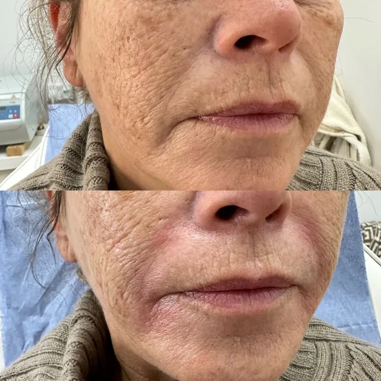 Nasolabial Folds and Marionette Lines - Before and After