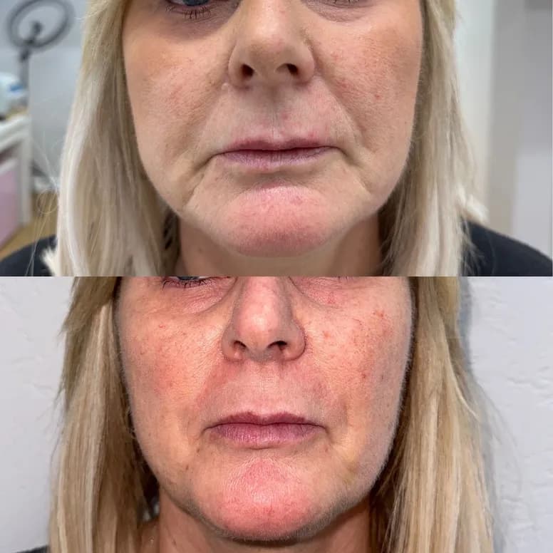 Nasolabial Folds and Marionette Lines - Before and After