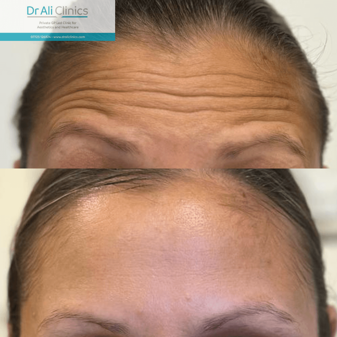 Dermal Filler Enhancement - Before and After