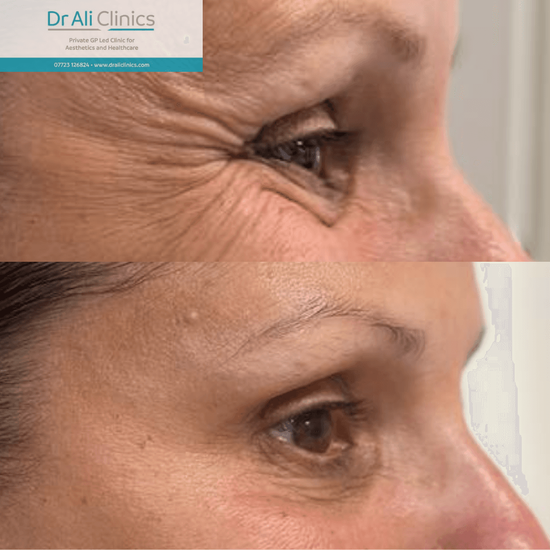 Lip Enhancement - Before and After