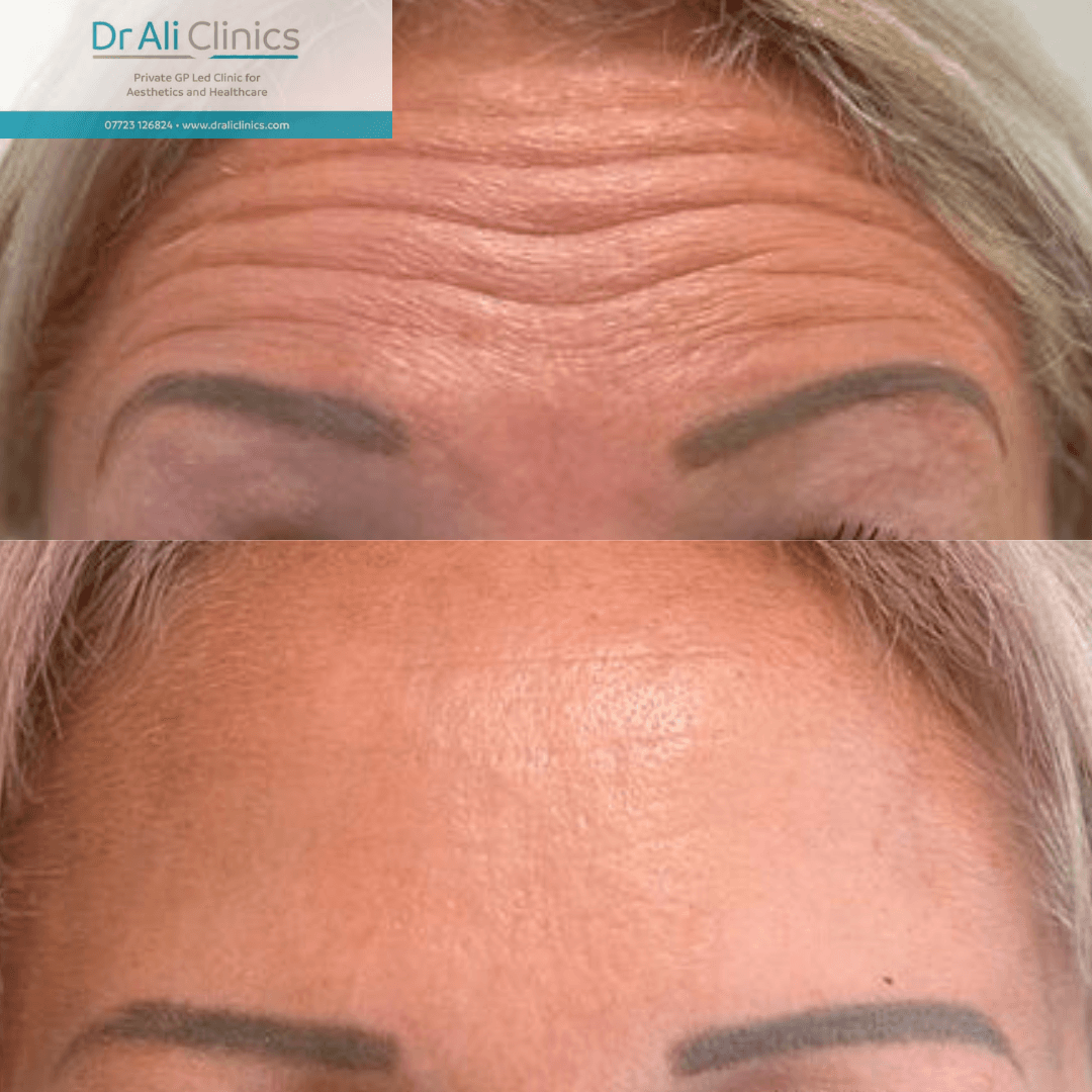 Cheek Augmentation - Before and After