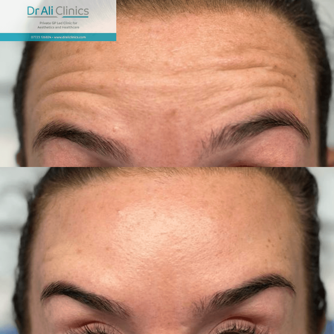 Anti-Wrinkle Treatment - Before and After