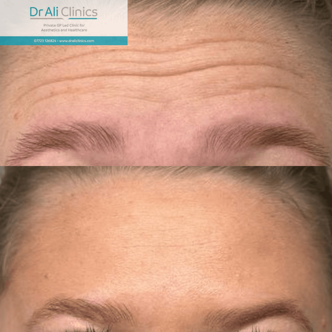 Crow's Feet Treatment - Before and After